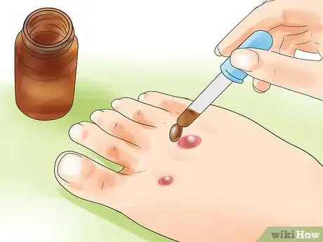 Image titled Make a Huge Blister Heal Step 11