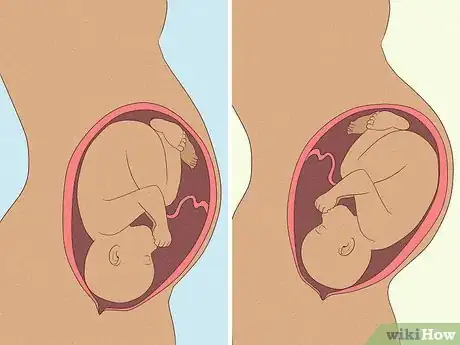 Image titled Tell if a Baby Is a Boy or Girl by the Heartbeat Step 4
