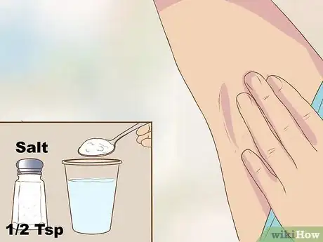 Image titled Get Rid of a Zit on Your Armpit Step 4