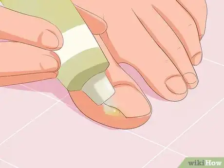 Image titled Remove Infection from an Ingrown Toenail Step 3