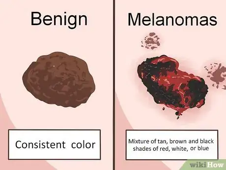 Image titled Recognize Melanoma Step 3