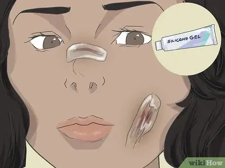 Image titled Prevent Scarring on Your Face Step 10