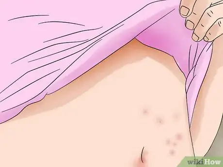 Image titled Identify Bed Bug Bites Step 2