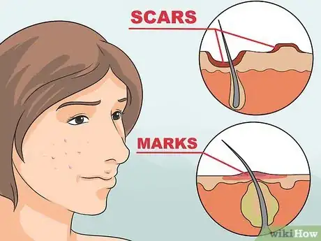 Image titled Get Rid of Red Acne Marks Step 1