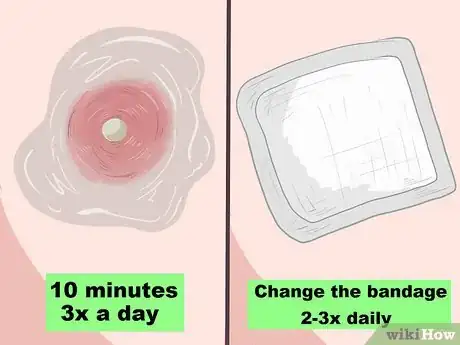 Image titled Recognize Staph Infection Symptoms Step 4