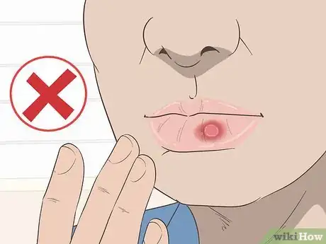 Image titled Get Rid of a Cold Sore with Home Remedies Step 11