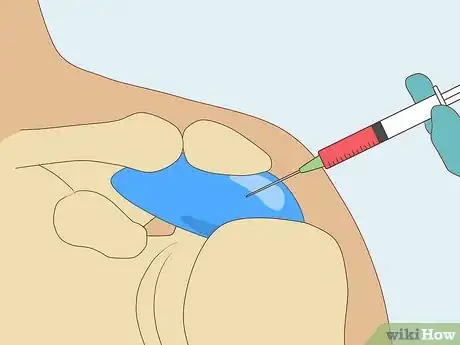 Image titled Treat Subacromial Bursitis Step 13