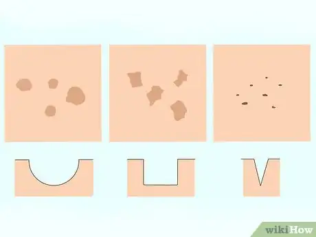 Image titled Get Rid of Acne Scars Fast Step 1