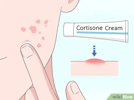 Image titled Get Rid of Acne Scars Fast Step 6