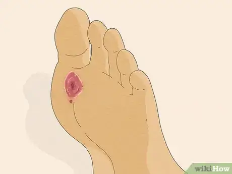 Image titled Know if You Have Neuropathy in Your Feet Step 5