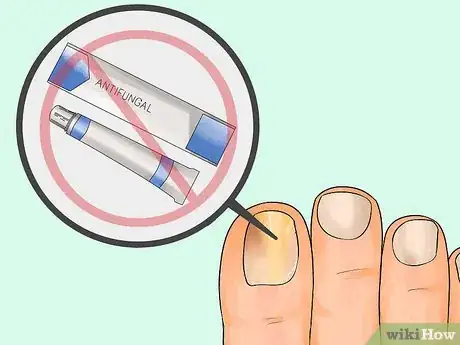 Image titled Get Rid of Toe Fungus Step 2