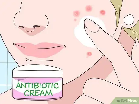 Image titled Get Rid of a Rash on Your Face Step 14