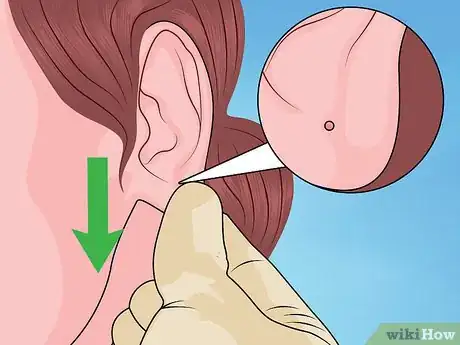 Image titled Reopen a Partially Closed Ear Piercing Hole Step 7