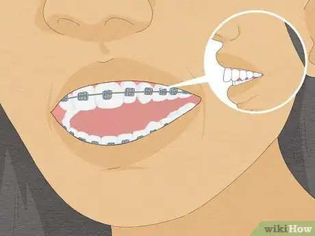 Image titled Fix Crooked Teeth Step 18