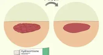 Treat Hypergranulation