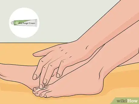 Image titled Get Rid of Foot Fungus at Home Step 01