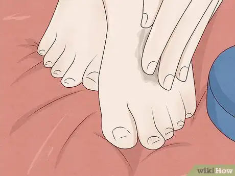 Image titled Remove Calluses Naturally Step 7