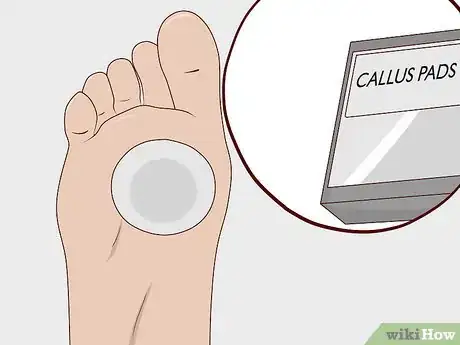Image titled Remove Calluses Naturally Step 3