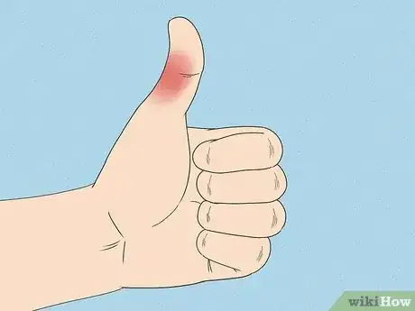 Image titled Diagnose a Broken Thumb Step 1