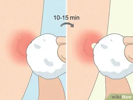 Image titled Instantly Get Rid of a Pimple (Cotton Ball Popping Method) Step 3