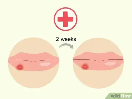 Image titled Treat Cold Sores with Essential Oils Step 10