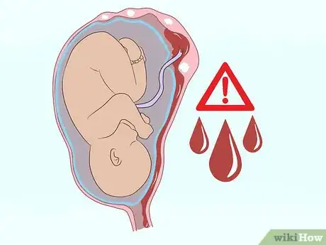 Image titled Deal with Fibroids During Pregnancy Step 9