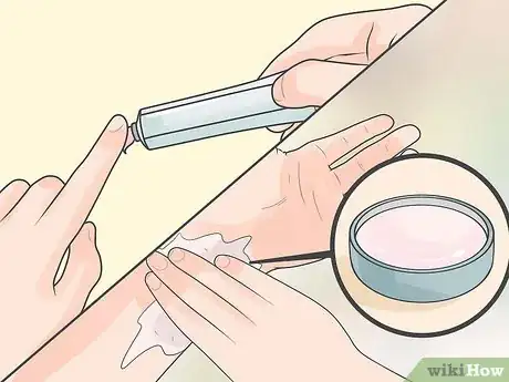 Image titled Remove an Ingrown Hair Under the Skin Step 11