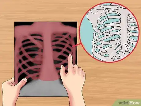 Image titled Read a Chest X Ray Step 15