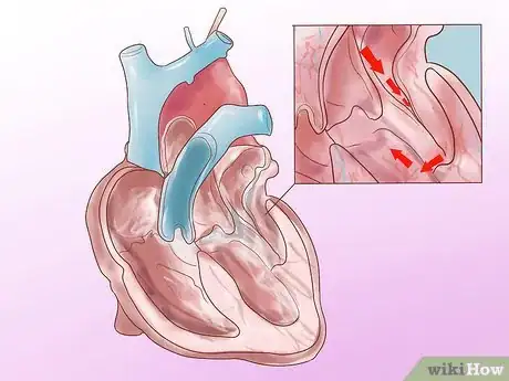 Image titled Recognize Congestive Heart Failure Symptoms Step 10