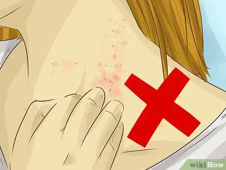 Image titled Stop Itching Step 1