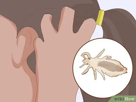 Image titled Prevent Lice Step 1