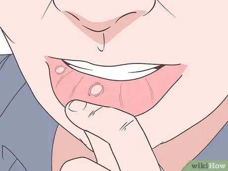 Image titled Prevent Mouth Ulcers Step 12