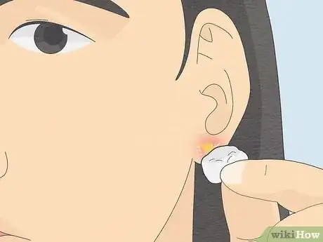 Image titled Clean Your Ear Piercing Step 7