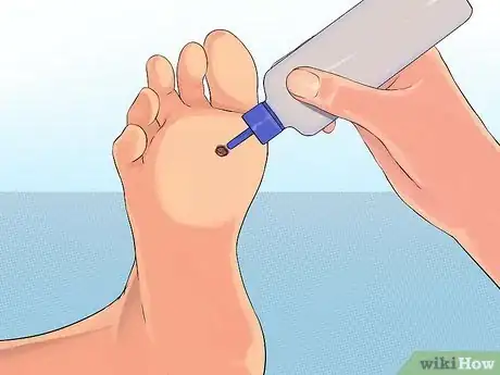 Image titled Get Rid of Plantar Warts (Verrucas) Step 5