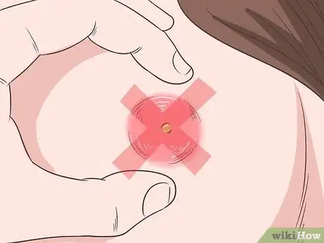 Image titled Get Rid of an Abscess Step 1