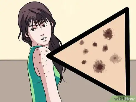 Image titled Recognize Skin Bacterial Infections Step 9