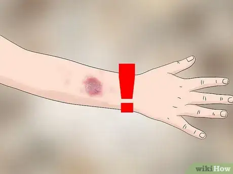 Image titled Identify Bed Bug Bites Step 4