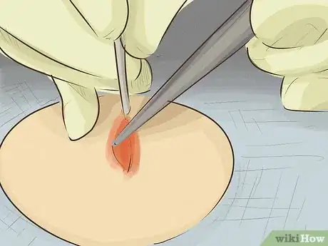 Image titled Remove a Cyst on Your Face Step 7