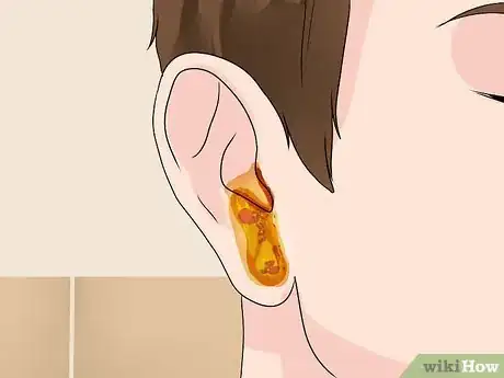 Image titled Treat an Outer Ear Infection Step 2