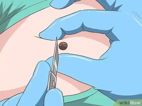 Image titled Remove Moles Without Surgery Step 4