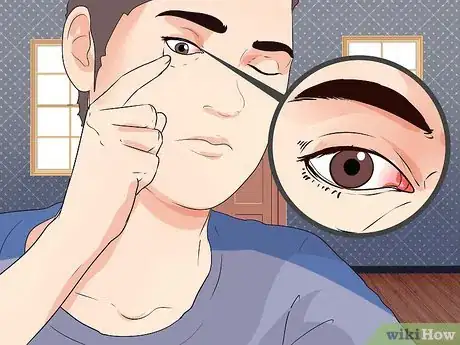 Image titled Remove a Speck From Your Eye Step 8
