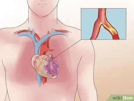 Image titled Recognize Congestive Heart Failure Symptoms Step 11