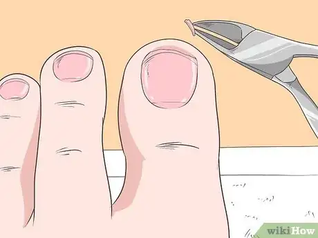 Image titled Fix Thick Toenails Step 3