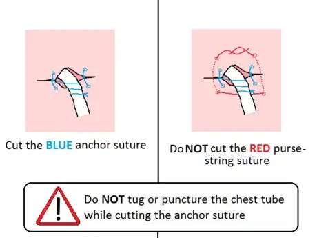Image titled 11 Cut the anchor suture.png
