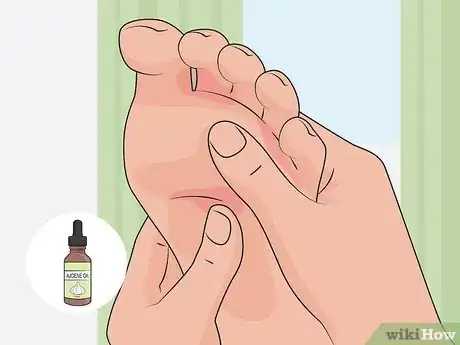 Image titled Get Rid of Foot Fungus at Home Step 07