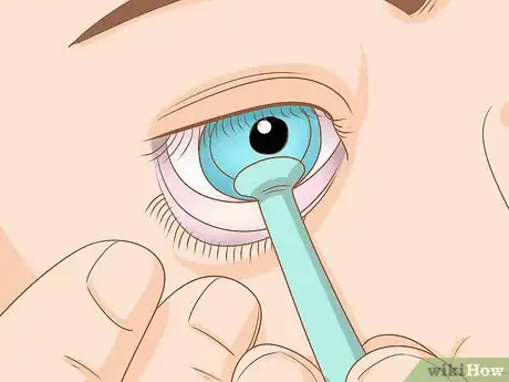Image titled Insert and Remove a Scleral Lens Step 10