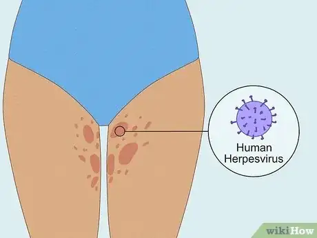 Image titled Get Rid of a Rash Between Your Legs Step 10