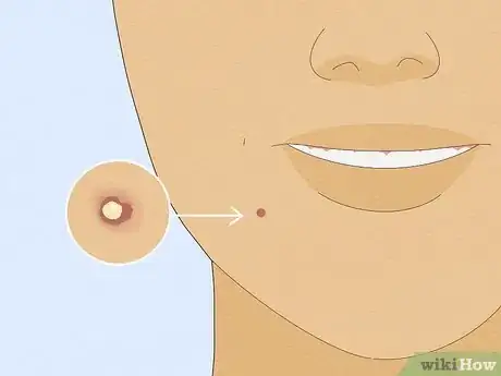 Image titled Get Rid of Pimples with Baking Soda Step 1