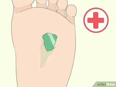 Image titled Get Glass out of Your Foot Step 7