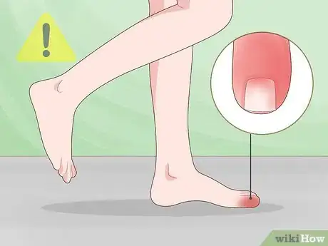 Image titled Prevent Ingrown Nails Step 7